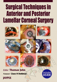 Surgical Techniques in Anterior and Posterior Lamellar Corneal Surgery 