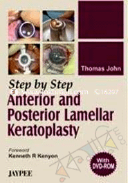Step by Step Anterior and Posterior Lamellar Keratoplasty 