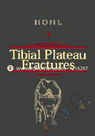 Tibial Plateau Fractures 