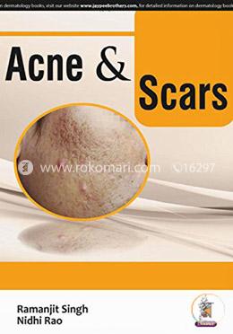 Acne and Scars  image