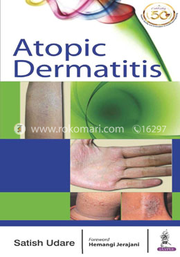 Atopic Dermatitis image