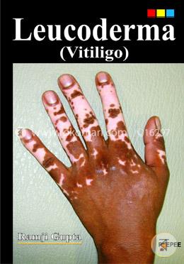 Leucoderma (Vitiligo) image