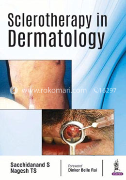 Sclerotherapy in Dermatology image