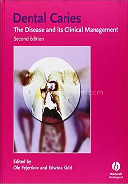 Dental Caries: The Disease and Its Clinical Management image