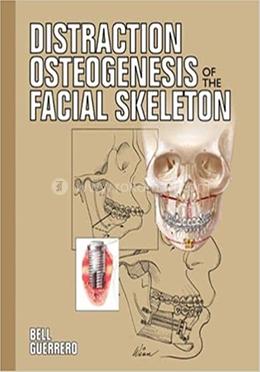Distraction Osteogenesis of the Facial Skeleton image