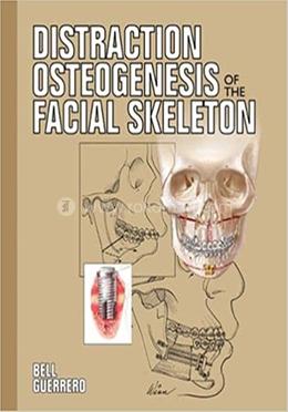 Distraction Osteogenesis of the Facial Skeleton