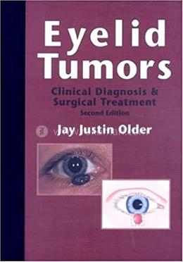 Eyelid Tumors image