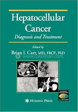 Hepatocellular Cancer: Diagnosis and Treatment image