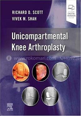 Unicompartmental Knee Arthroplasty image