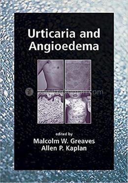 Urticaria and Angioedema image