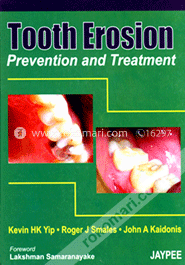 Tooth Erosion Prevention and Treatment image