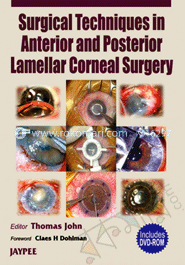 Surgical Techniques in Anterior and Posterior Lamellar Corneal Surgery 