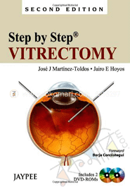 Step By Step Vitrectomy image
