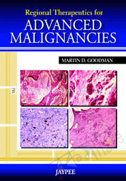 Regional Therapeutics For Advanced Malignancies image