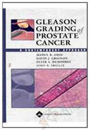 Gleason Grading Of Prostate Cancer: A Contemporary Approach image