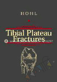Tibial Plateau Fractures image