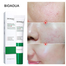 BIOAQUA Natural Salicylic Acid for Acne Face Cream Cleaning Pores Repairing Acne Spots Controlling Moisturizing Skin Remove Acne Marks-20gm image