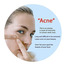 Bioaqua Acne Removal Sheet Mask 30 gm image