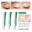 Breylee Acne Scar Removal Cream - 30gm image