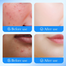 Sadoer Salicylic Acid Acne Patch - 36 Pcs image